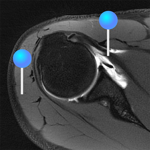 Mri Arthrogram Shoulder MR Arthrogram | e-Anatomy
