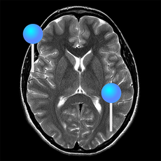 Gehirn Axialschnitt-MRT mit Stiften